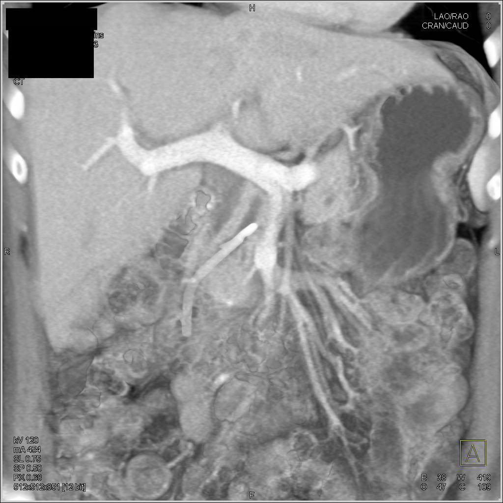 Ampullary Tumor with Stent in Pancreatic Duct - CTisus CT Scan