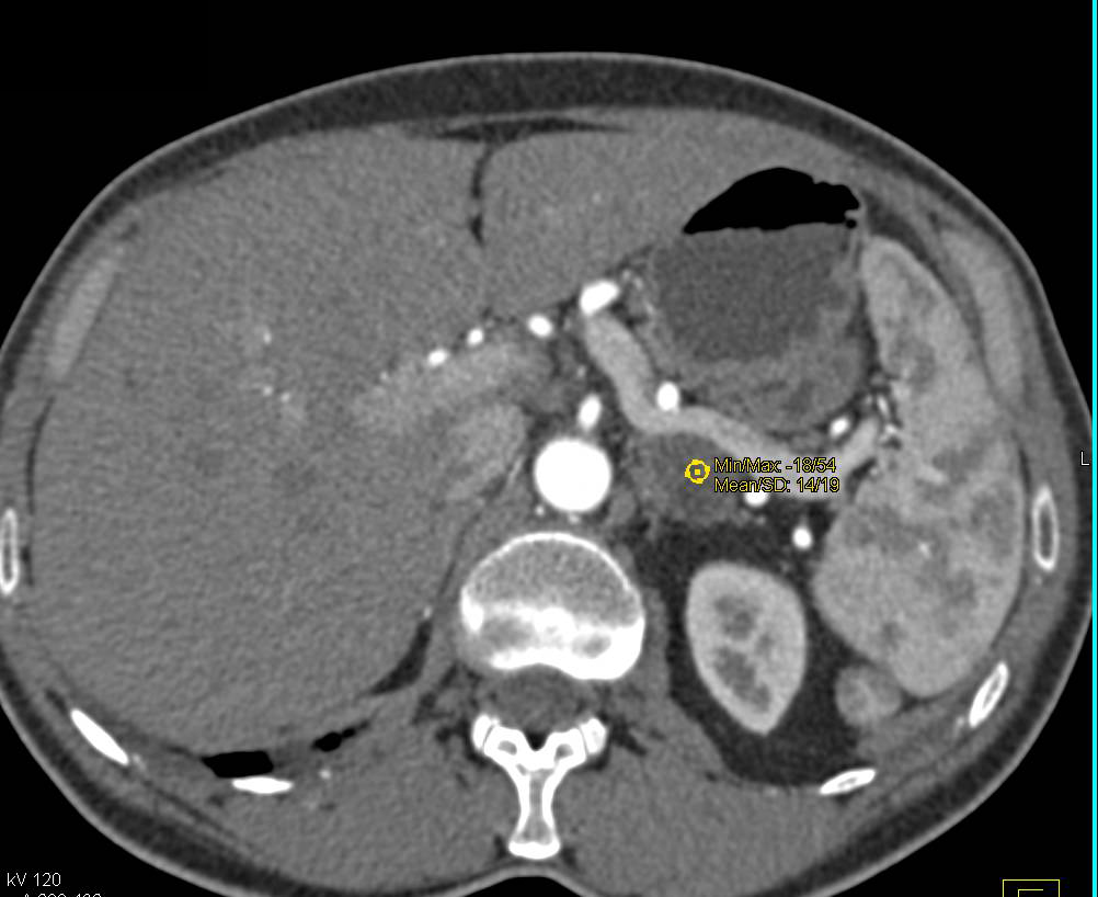 Multiple Pancreatic Intraductal Papillary Mucinous Neoplasms (IPMNs) - CTisus CT Scan