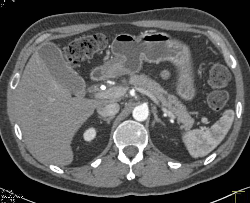 Subtle Pancreatic Adenocarcinoma with Dilated Pancreatic Duct - CTisus CT Scan