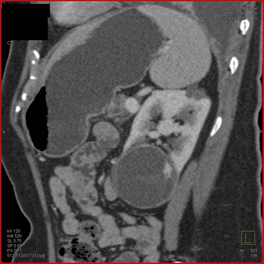 Pancreatic Adenocarcinoma and Incidental Cystic Renal Cell Carcinoma - CTisus CT Scan