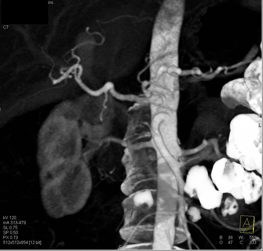 Pancreatic Adenocarcinoma Encases the Celiac and Hepatic Artery - CTisus CT Scan