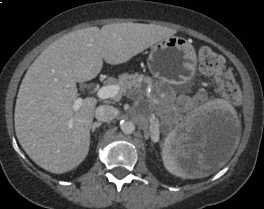 Unusual Case of Pancreatic Cancer in Tail of Pancreas Infiltratiing the Spleen - CTisus CT Scan