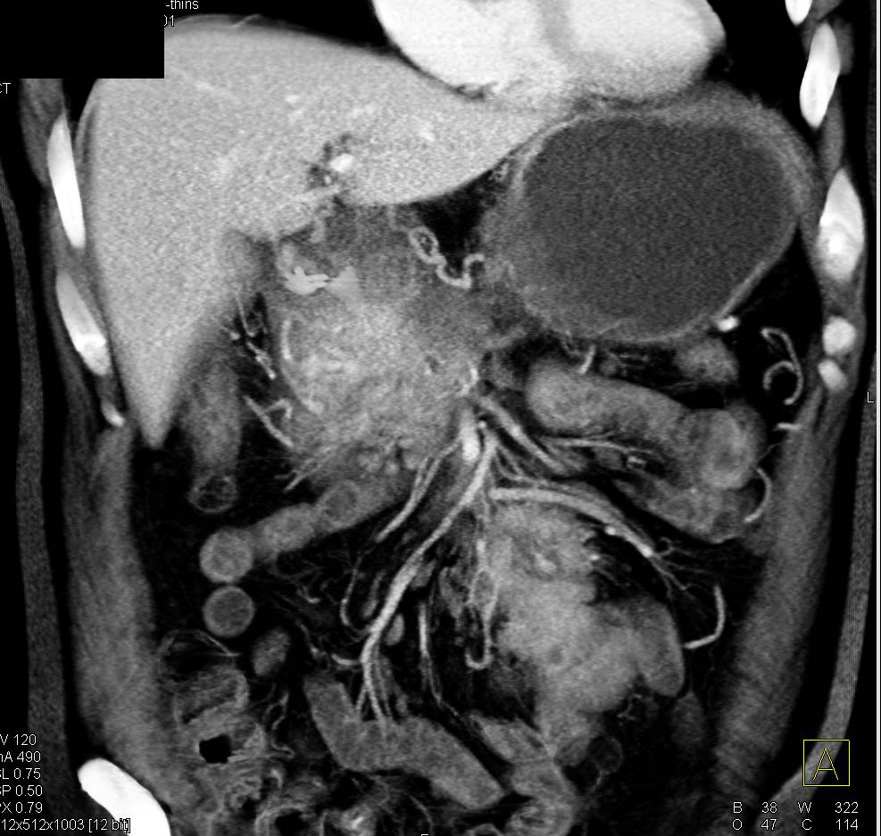 Pancreatic Cancer in a Patient with a History of Prior Pancreatitis - CTisus CT Scan