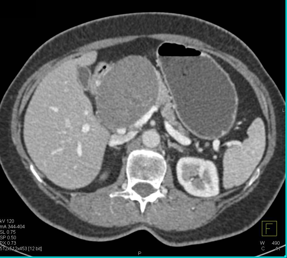 Paraganglioma Simulates a Pancreatic Mass - CTisus CT Scan