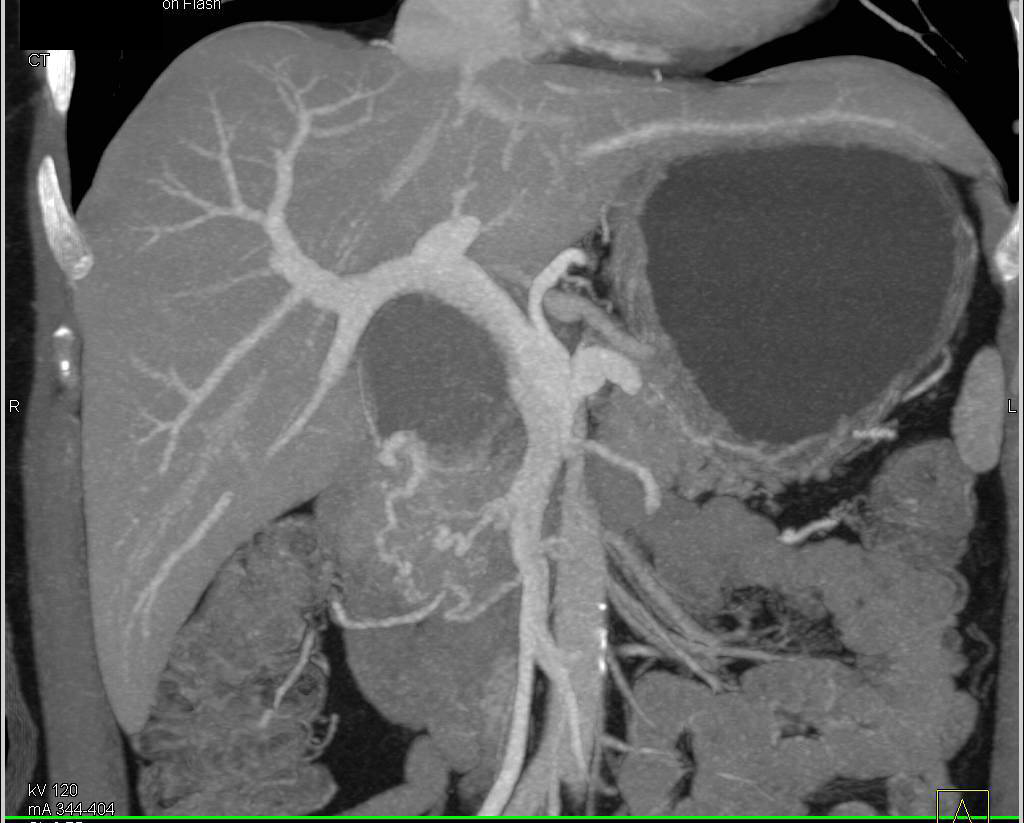 Schwannoma Simulates a Pancreatic Mass - CTisus CT Scan