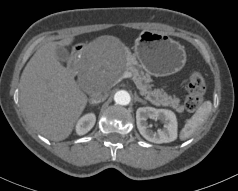 Ganglioneuroma Simulating a Pancreatic Mass - CTisus CT Scan