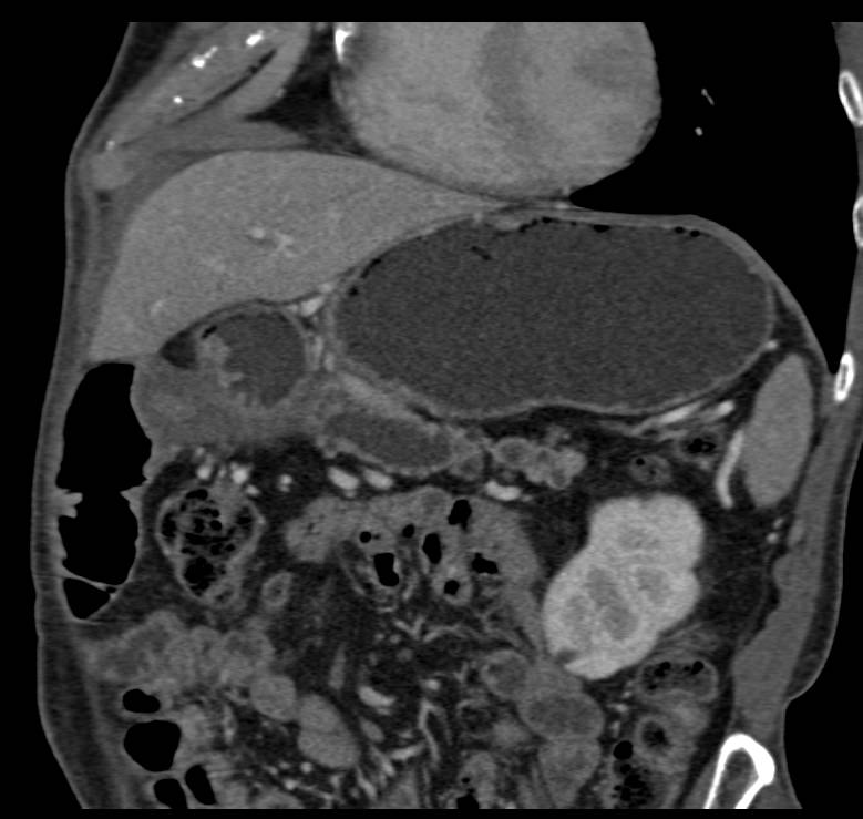 Central Intraductal Papillary Mucinous Neoplasm (IPMN) - CTisus CT Scan