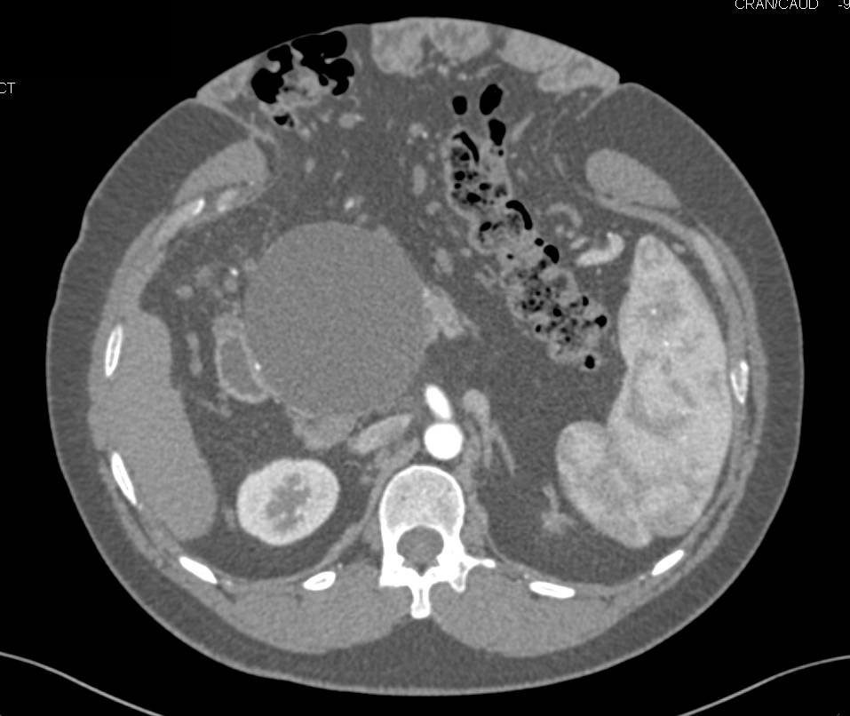 Pancreatic Pseudocyst with Dilated Pancreatic Duct - CTisus CT Scan