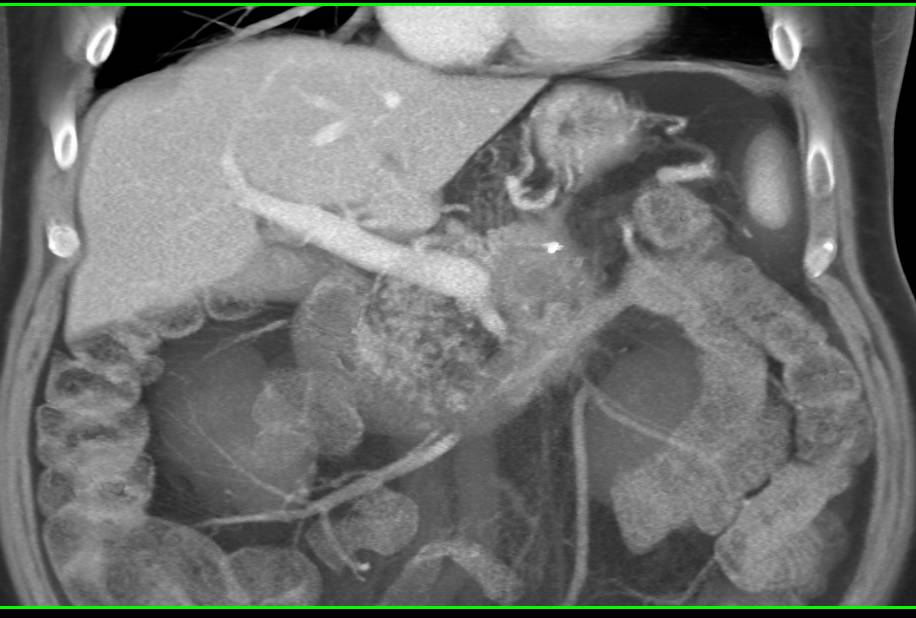 Recurrent Pancreatic Cancer Involves the Tail of the Pancreas - CTisus CT Scan