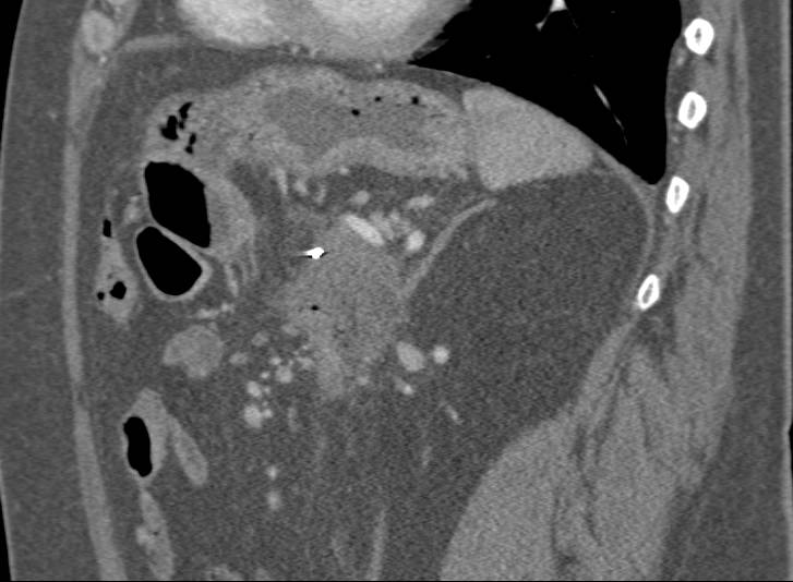 Recurrent Pancreatic Cancer - CTisus CT Scan