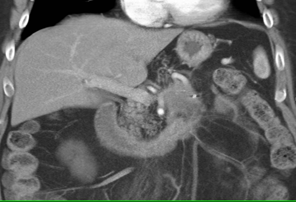 Carcinoma of the Tail of the Pancreas - CTisus CT Scan