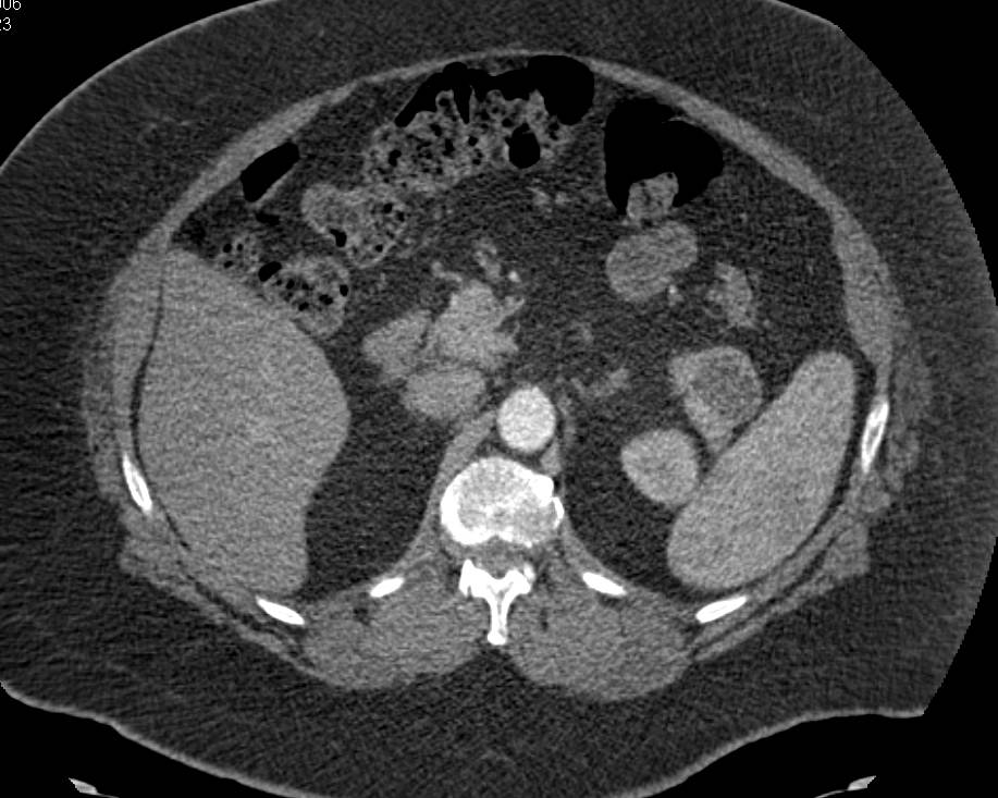 Mucinous Cystic Neoplasm (MCN) in Tail of the Pancreas - CTisus CT Scan