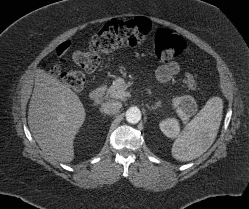 Intraductal Papillary Mucinous Neoplasm (IPMN) looks like a Cystic Pancreas Mass like Mucinous Cystic Neoplasm (MCN) - CTisus CT Scan