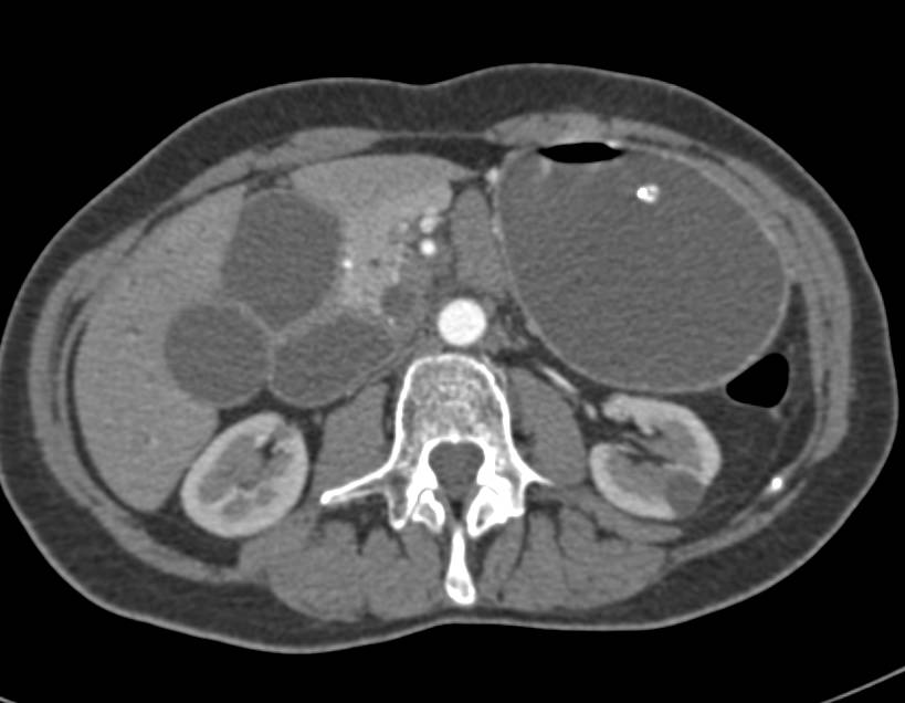 Pancreatic Cancer Invades and Obstructs the Duodenum - CTisus CT Scan