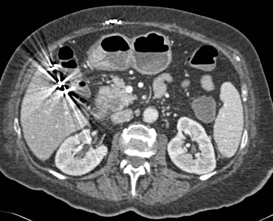 Subtle Carcinoma of the Head of the Pancreas - CTisus CT Scan