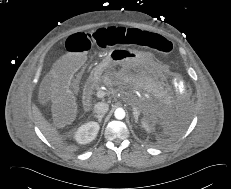 Pancreatitis with Pancreatic Necrosis - CTisus CT Scan