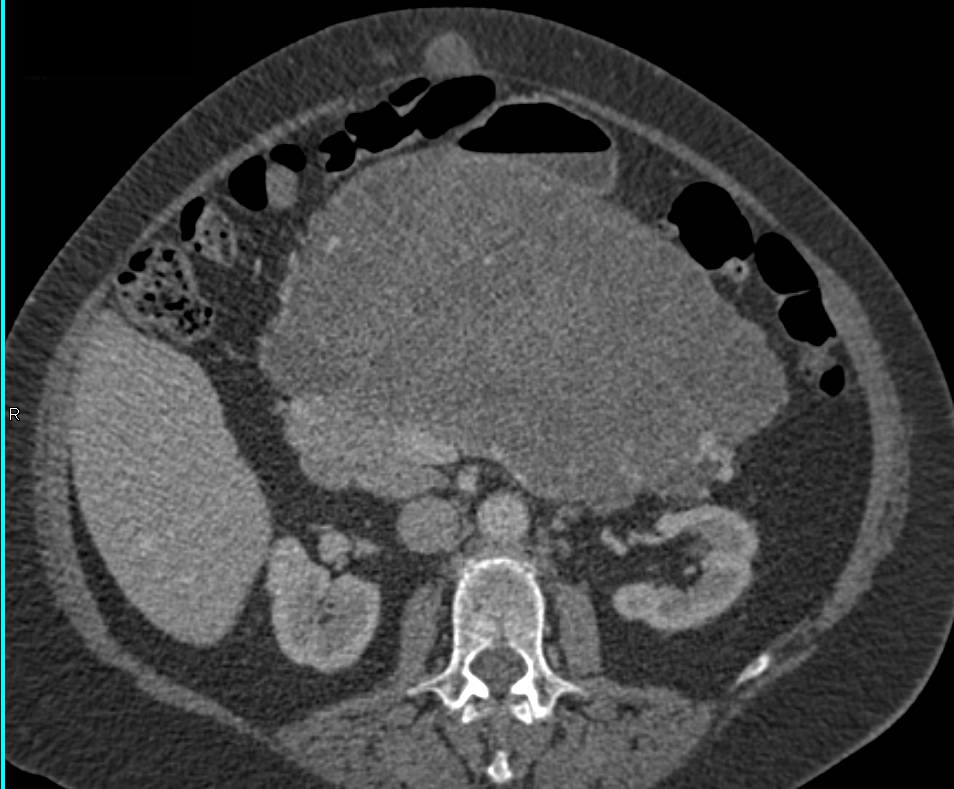 Serous Cystadenoma of the Body of the Pancreas - CTisus CT Scan