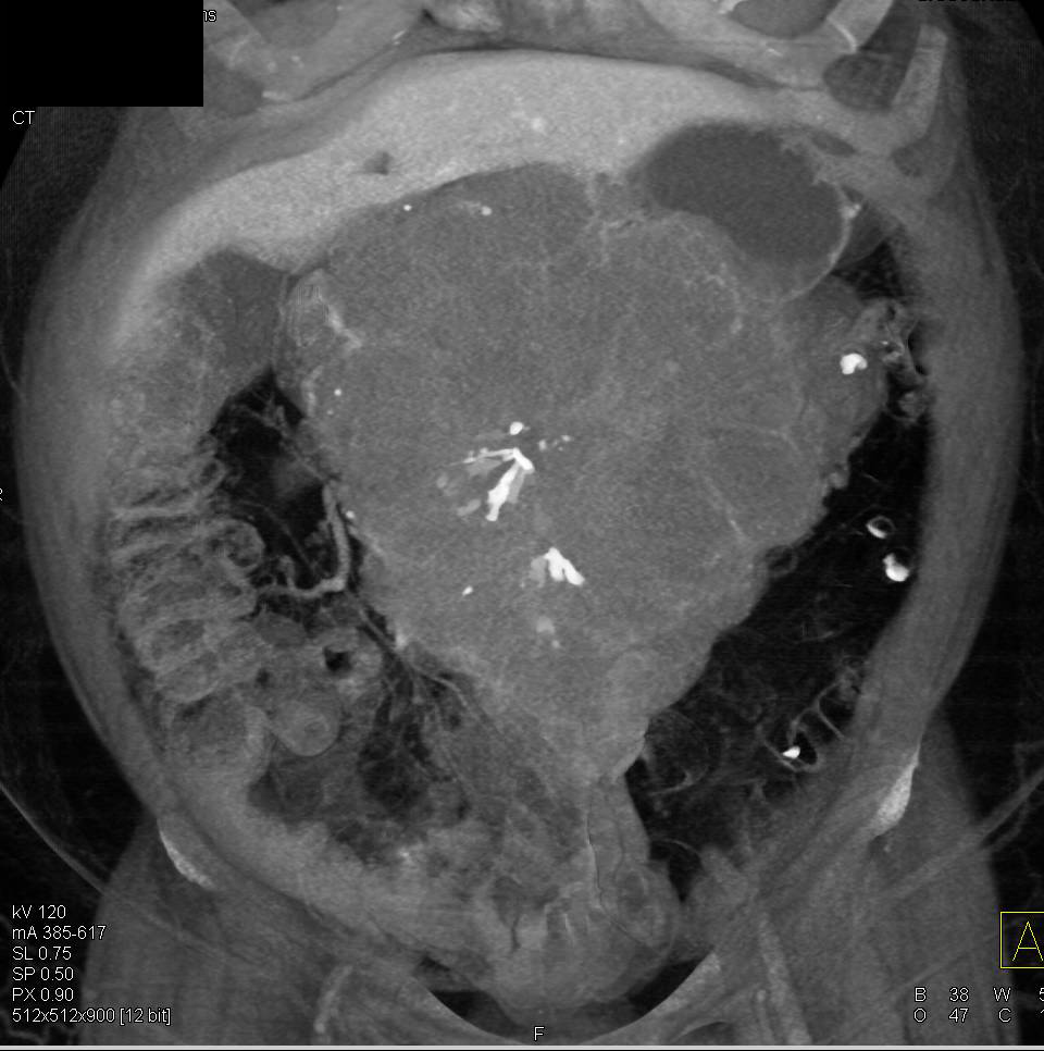 Serous Cystadenoma with Stellate Calcifications - CTisus CT Scan