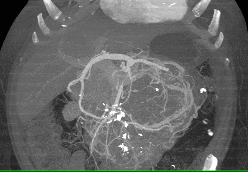 Serous Cystadenoma of the Body of the Pancreas - CTisus CT Scan