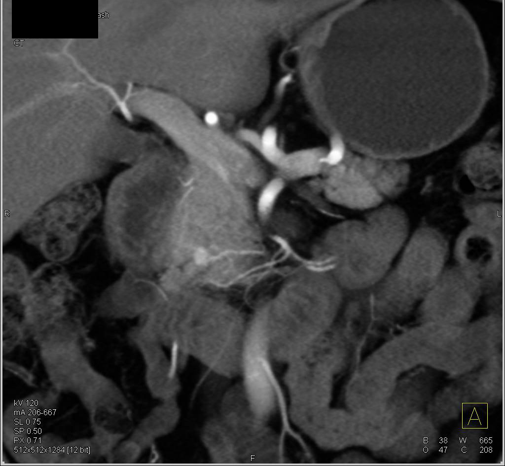 Metastatic Renal Cell Carcinoma to the Pancreas with Vascular Metastases - CTisus CT Scan