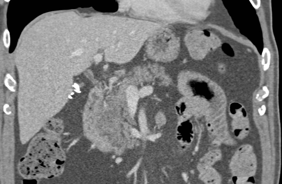 Fatty Infiltration of the Head of the Pancreas - CTisus CT Scan