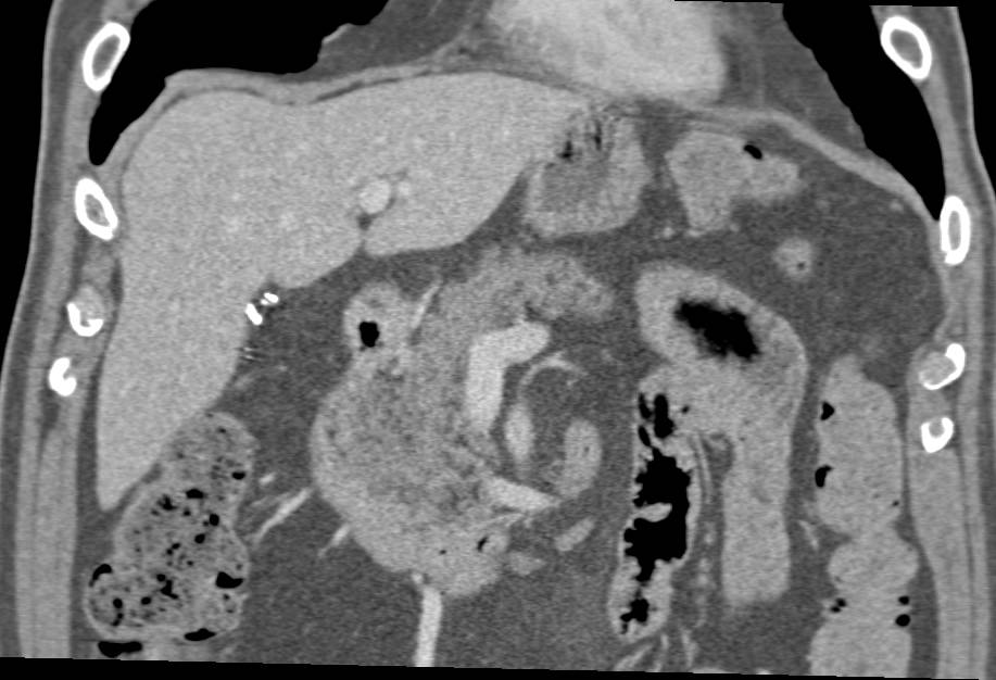 Fatty Infiltration of the Head of the Pancreas - CTisus CT Scan