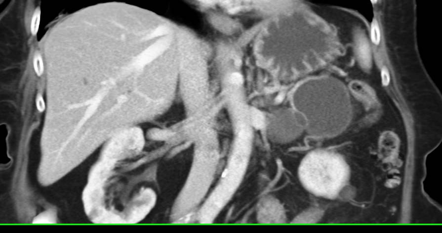 Dilated Pancreatic Duct with Multiple Central Intraductal Papillary Mucinous Neoplasms (IPMNs) - CTisus CT Scan