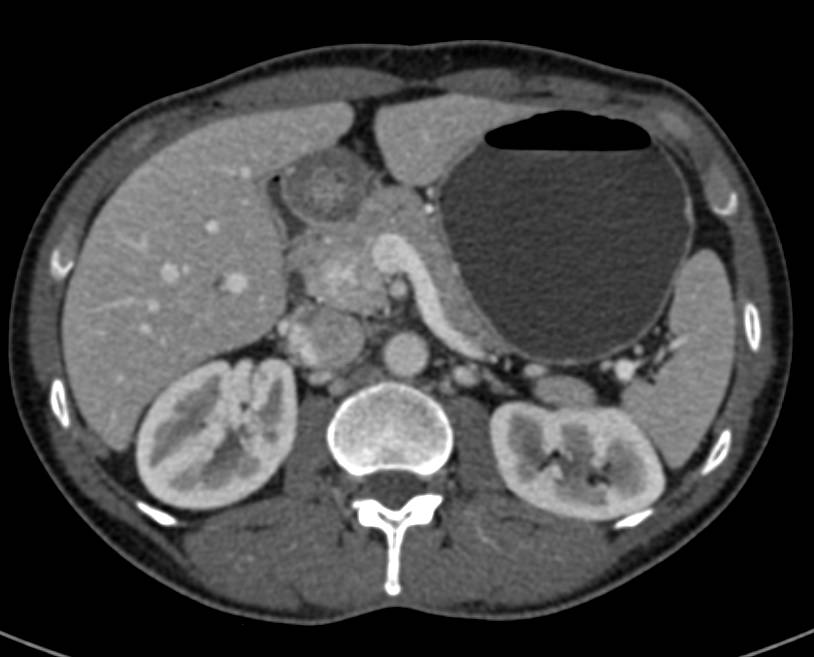 Neuroendocrine Tumor in Head of Pancreas Seen Only On Arterial Phase Images - CTisus CT Scan