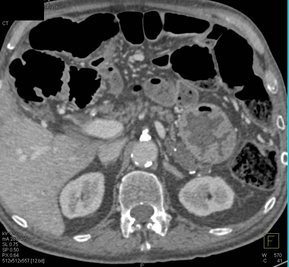 Chronic Pancreatitis - CTisus CT Scan