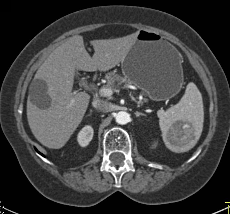 Neuroendocrine Tumor of the Pancreas with Splenic Hemangiomas - CTisus CT Scan