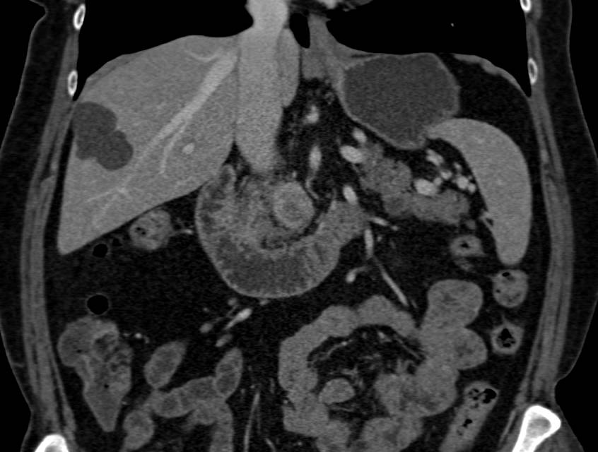 Neuroendocrine Tumor in Head of the Pancreas - CTisus CT Scan