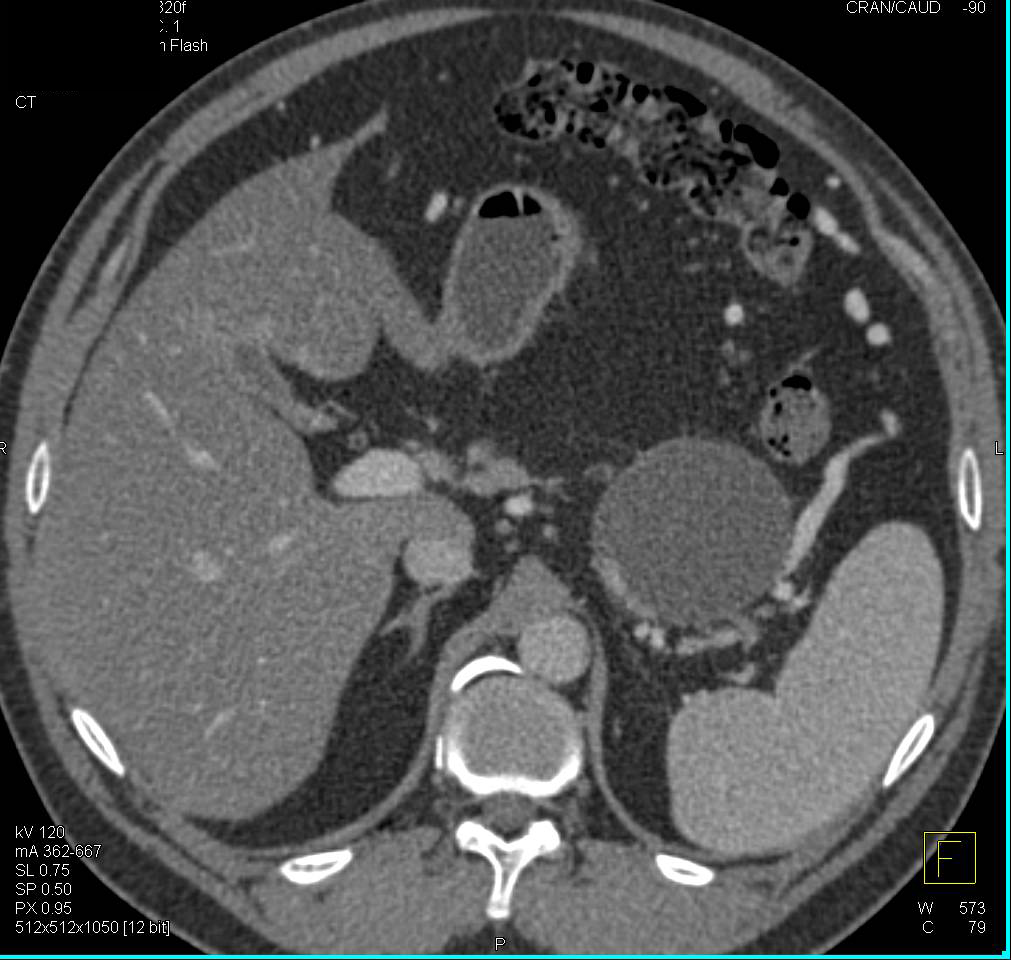 Mucinous Cystic Neoplasm of the Pancreas - CTisus CT Scan