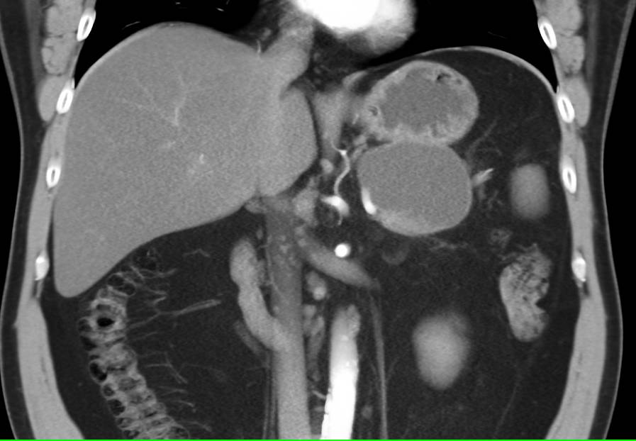 Serous Cystadenoma - CTisus CT Scan