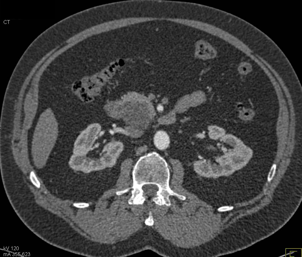 Serous Cystadenoma in the Head of the Pancreas - CTisus CT Scan