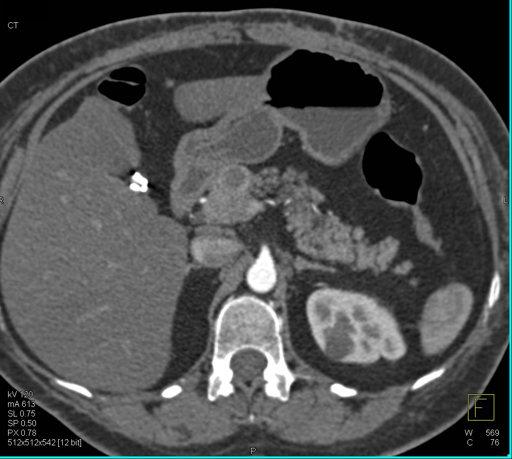 Cystic Neuroendocrine Tumor in the Body of the Pancreas - CTisus CT Scan