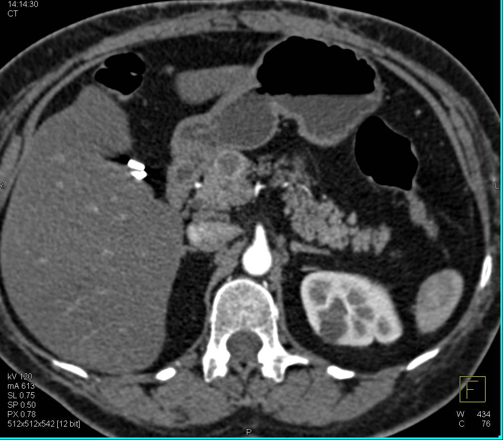 Cystic Pancreatic Neuroendocrine Tumor with Peripheral Enhancement - CTisus CT Scan