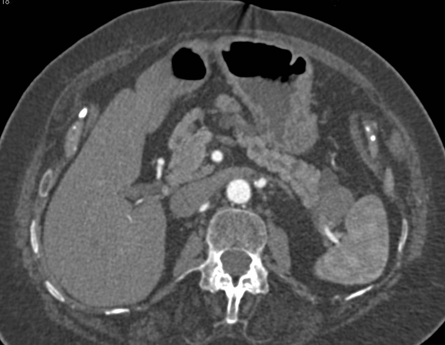 Multiple Intraductal Papillary Mucinous Neoplasms (IPMNs) with Largest in the Tail of the Pancreas - CTisus CT Scan