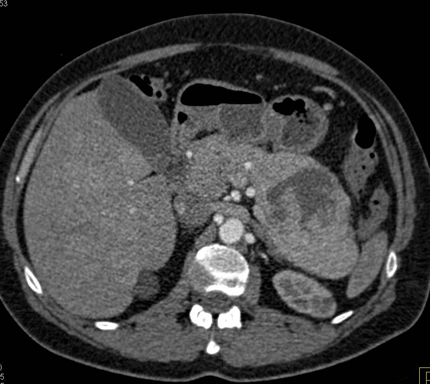 Neuroendocrine Tumor of the Pancreatic Tail with Liver Metastases - CTisus CT Scan