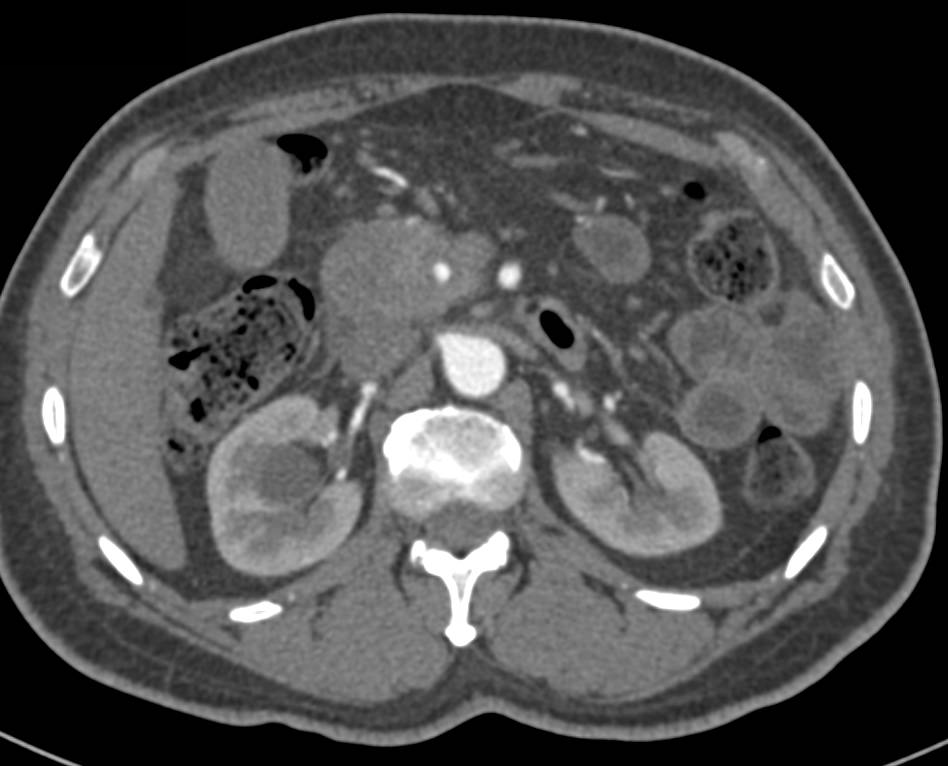 Pancreatic Adenocarcinoma with Arterial Encasement and Pancreatic Duct Dilatation - CTisus CT Scan