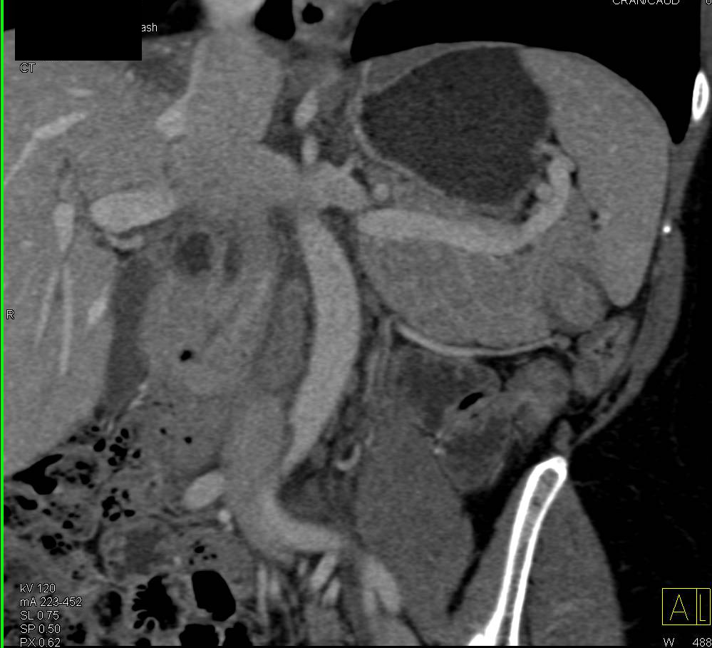 Castleman Disease in Tail of Pancreas (rare presentation) - CTisus CT Scan