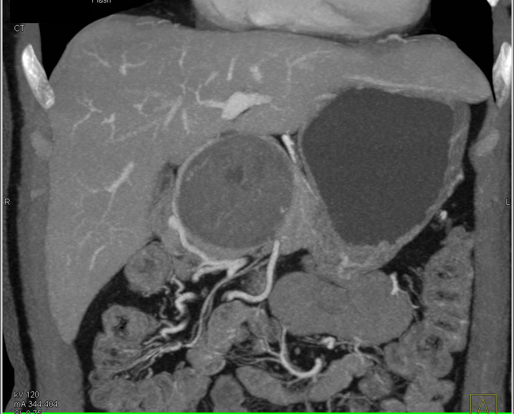 Neurogenic Tumor Near the Head of the Pancreas - CTisus CT Scan