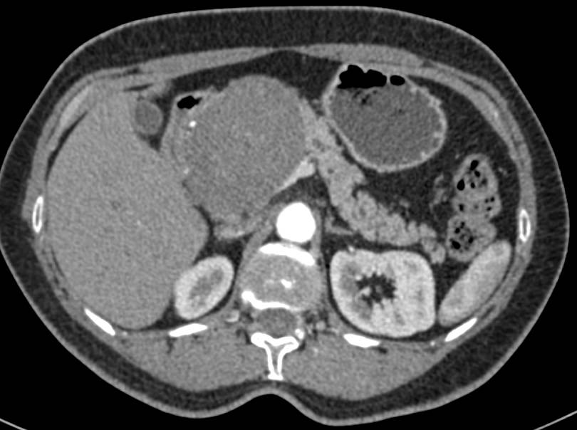 Neurogenic Tumor Simulates a Pancreatic Tumor - CTisus CT Scan