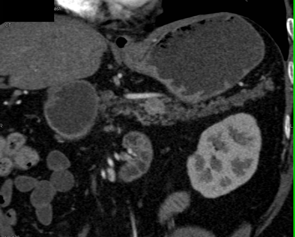 Duodenal Carcinoma and Incidental Neuroendocrine Tumor in the Body of the Pancreas - CTisus CT Scan