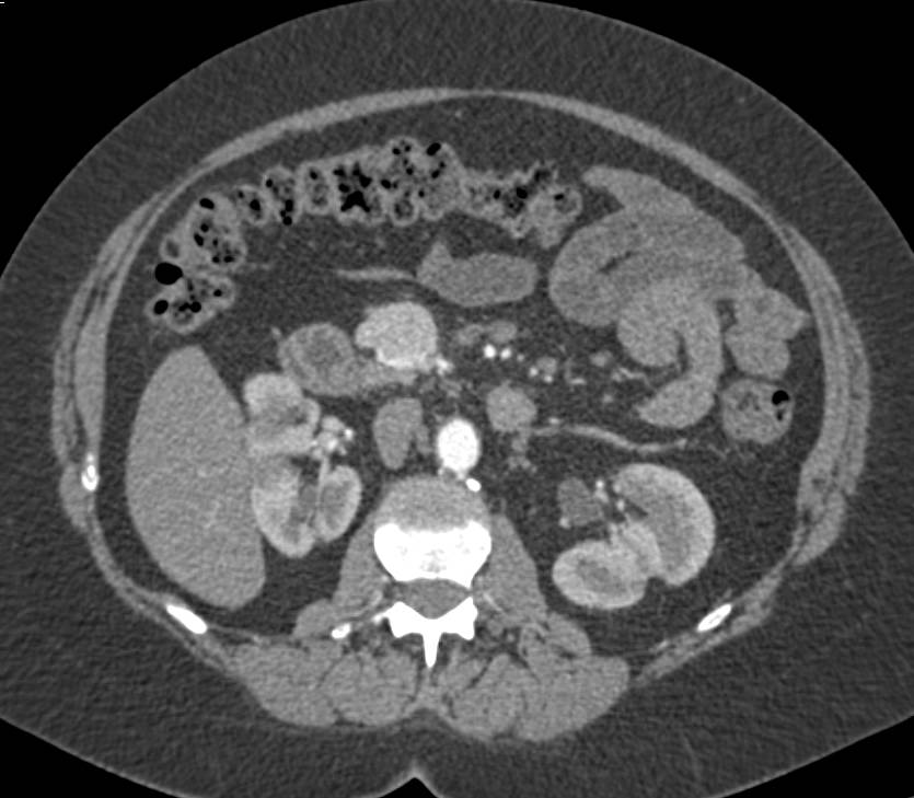 Neuroendocrine Tumor of the Pancreas with Marked Vascularity - CTisus CT Scan