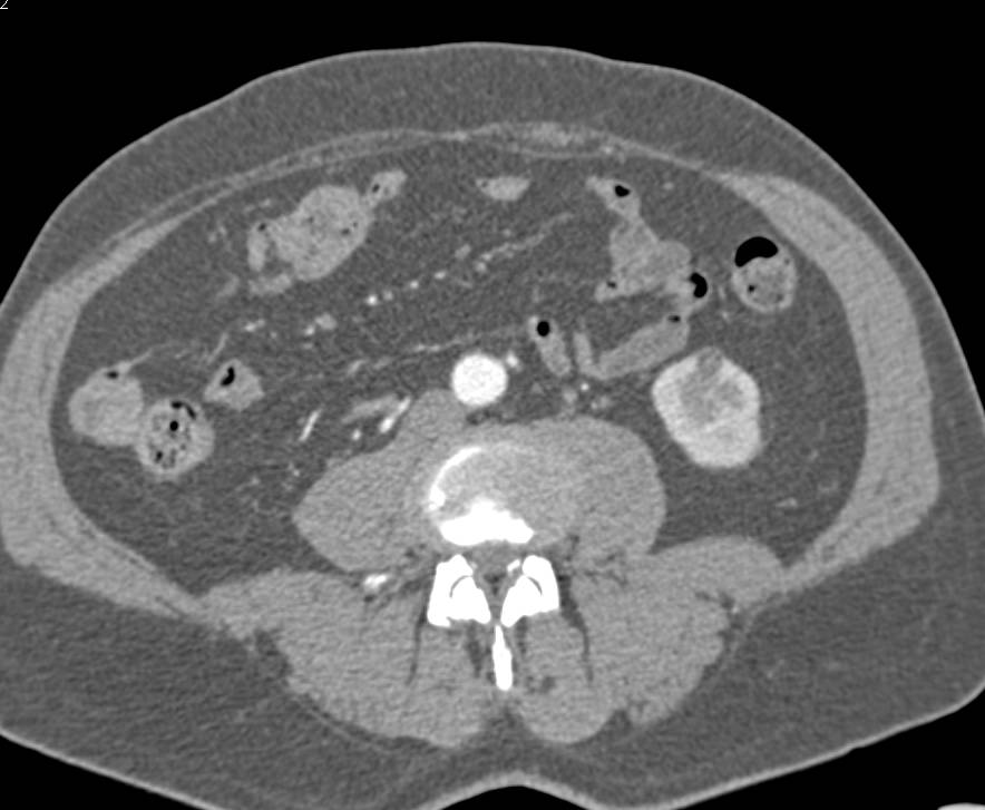 Right Nephrectomy for Carcinoma with Subtle Vascular Metastases to the Head of the Pancreas - CTisus CT Scan