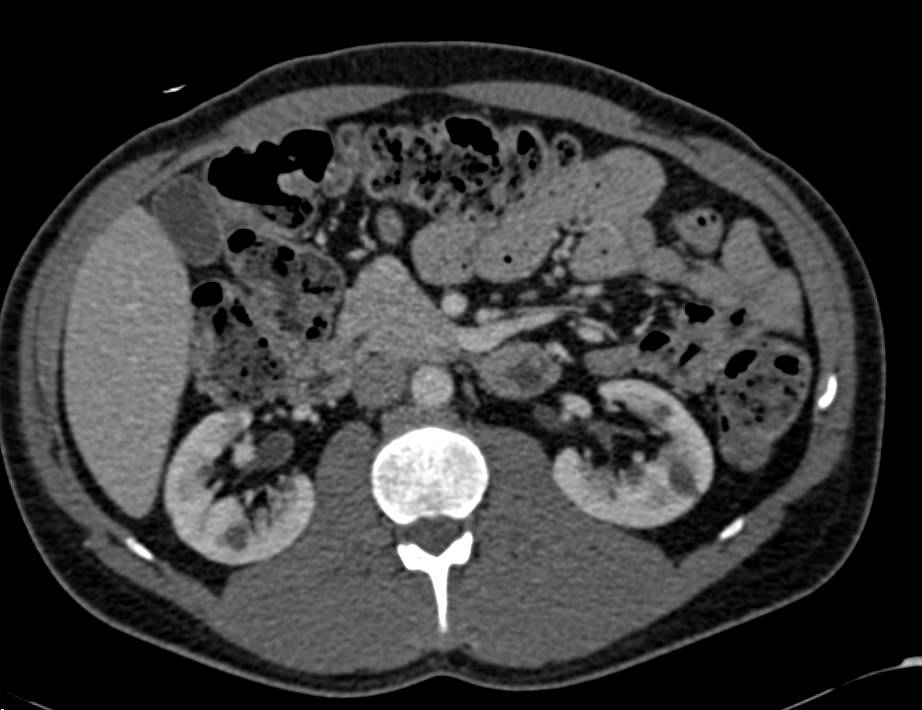 Neuroendocrine Tumor in the Tail of the Pancreas - CTisus CT Scan