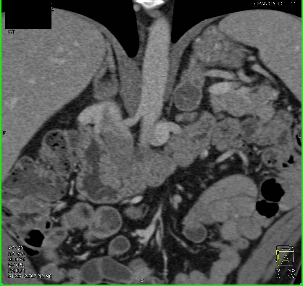 Neuroendocrine Tumor of the Tail of the Pancreas - CTisus CT Scan