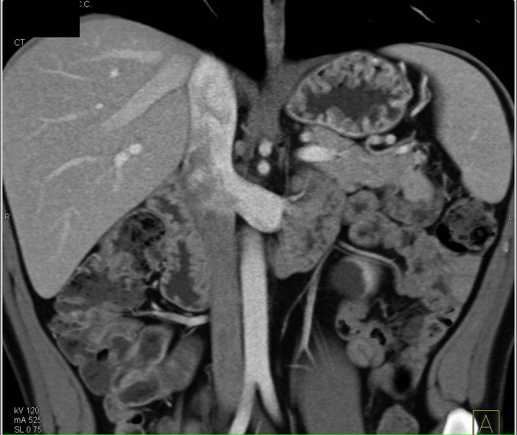 Neuroendocrine Tumor in the Tail of the Pancreas - CTisus CT Scan