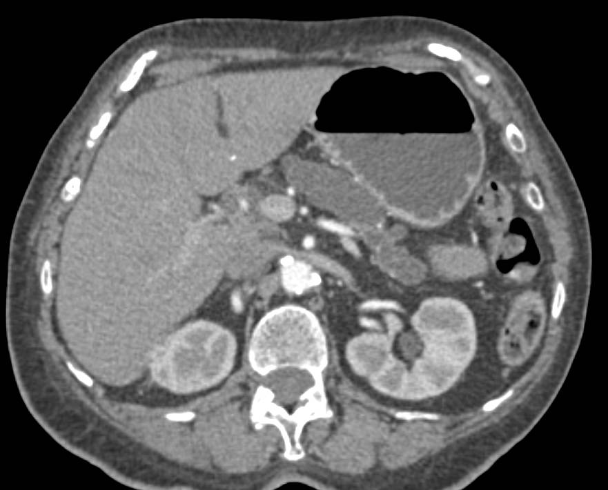 Chronic Pancreatitis with Calcifications and Dilated Pancreatic Duct - CTisus CT Scan