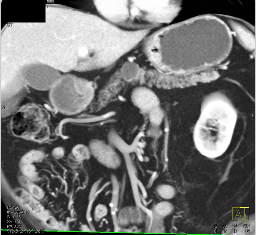 Intraductal Papillary Mucinous Neoplasm (IPMN) in the Body of the Pancreas - CTisus CT Scan